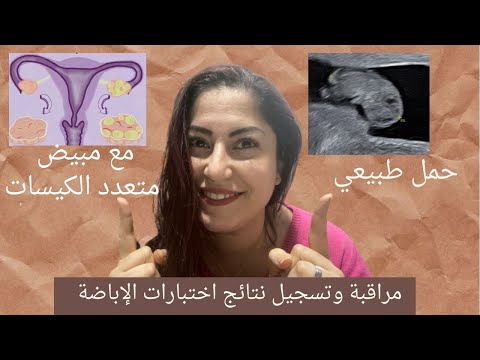 فيديو: 4 طرق للإباضة مع متلازمة تكيس المبايض (PCOS)