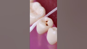 Temporary cavity relief hack #shorts