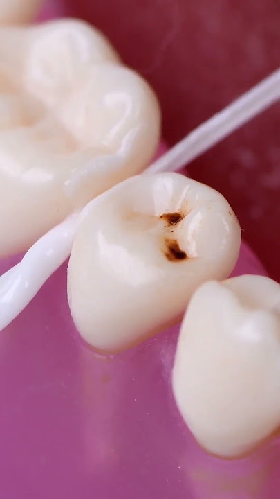 Temporary cavity relief hack #shorts