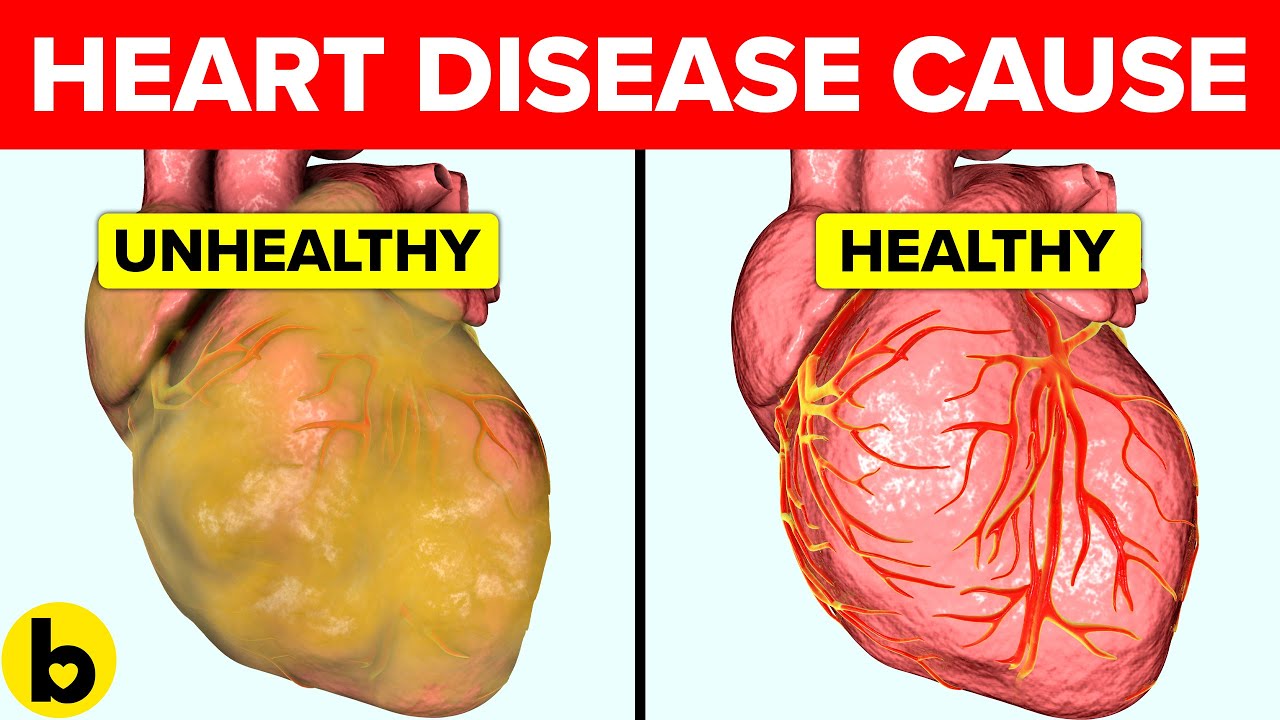 What Causes Heart Disease and How Can You Prevent It? YouTube