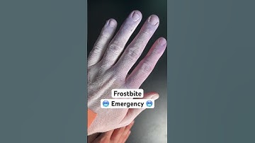 Frostbite? Try this… #medical #health #survival