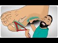 How to fix bunions  flat feet at the same time