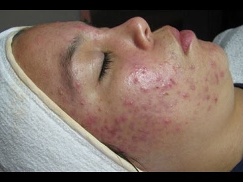 Масло чайного дерева от черных точек