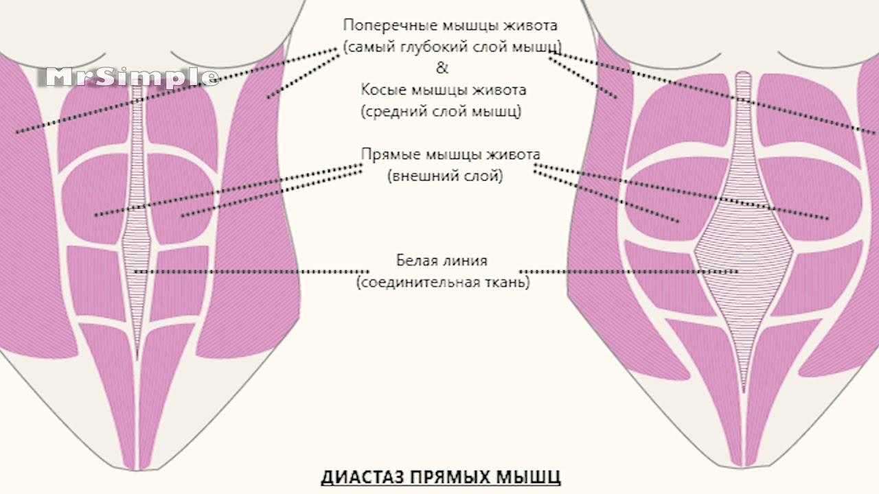 Операция на мышцы живота. Расхождение мышц живота после родов диастаз. Диастаз мышц белой линии. Диастаз прямой мышцы беременность. Диастаз мышц белой линии живота.