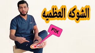 الشوكه العظميه أسبابها وعلاجها|علاج الم والتهاب الكعب|علاج مسمار القدم|دكتور احمد هيكل