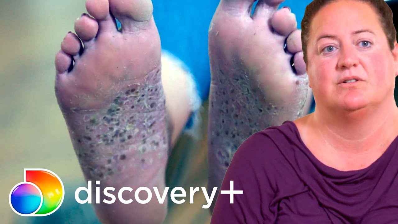 Paciente cobre os seus pés por causa de suas estranhas bolhas | Dra. Sandra Lee: A Rainha dos Cravos
