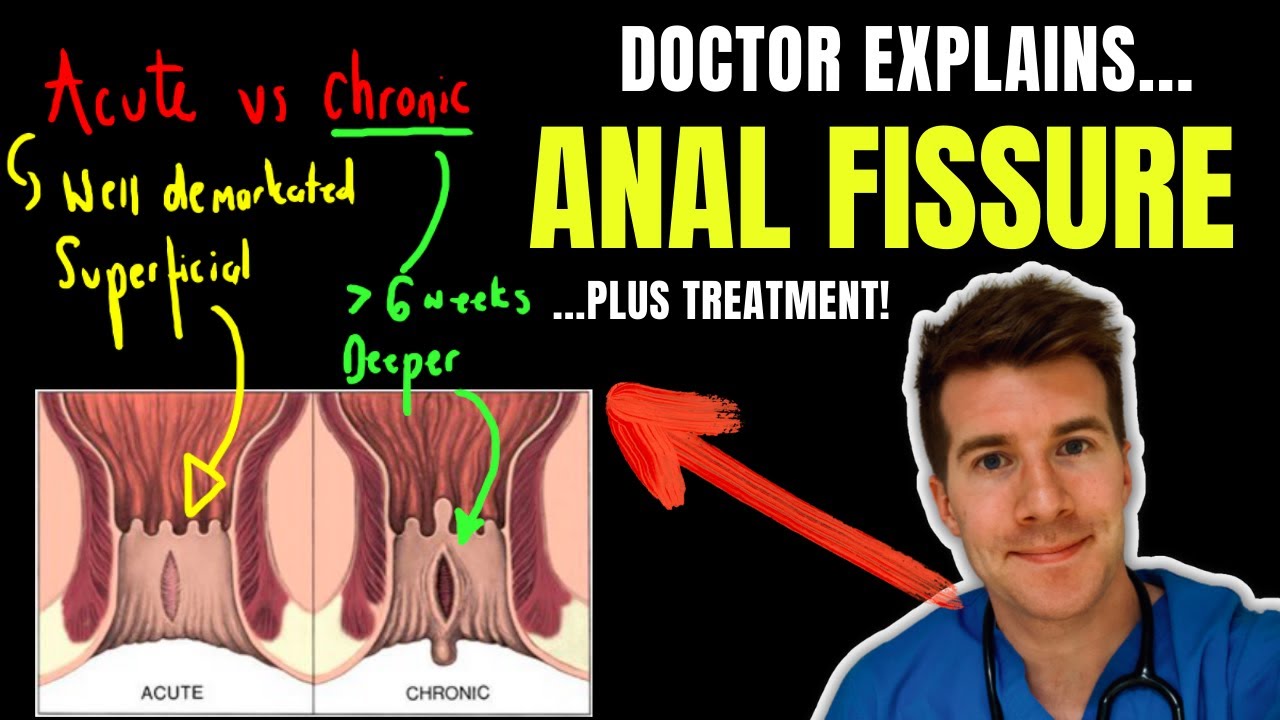 Doctor Explains Anal Fissure Including Causes Classification And
