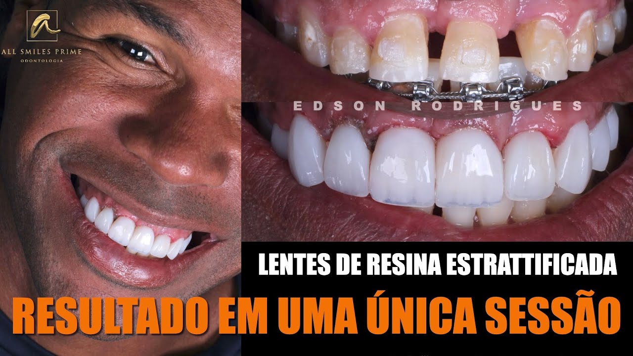 FECHANDO DIASTEMAS EM UMA SESSÃO!