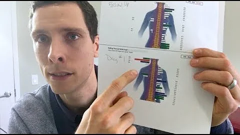 Indicators of Nerve Pressure: Infrared Thermography and Surface Electromyography (sEMG)