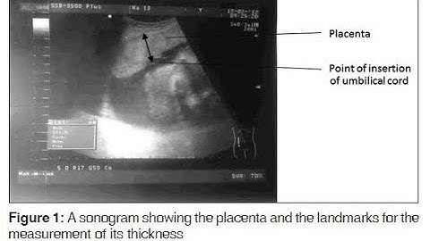 Using Placenta thickness to Estimate Fetal gestation age on Ultrasound