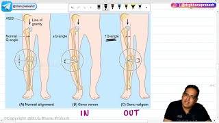 Valgus And Varus Deformities (Hindi) : Orthopedic Lectures