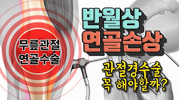 무릎연골 손상 반월상 관절경 수술 꼭 해야할까? 관절내시경 수술 결정 전 필수시청