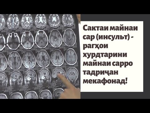 Сактаи майнаи сар (инсульт) - рагҳои хурдтарини майнаи сарро тадриҷан мекафонад!