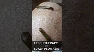 psoriasis treatment ll psoriasis skin disease anaghayurvedapsoriasis psoriasissolution