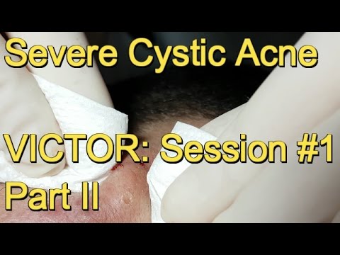 Severe Cystic Acne - VICTOR:  Session #  Part II