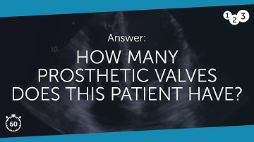 60 Seconds of Echo Teaching Question: How many prosthetic valves does this patient have?
