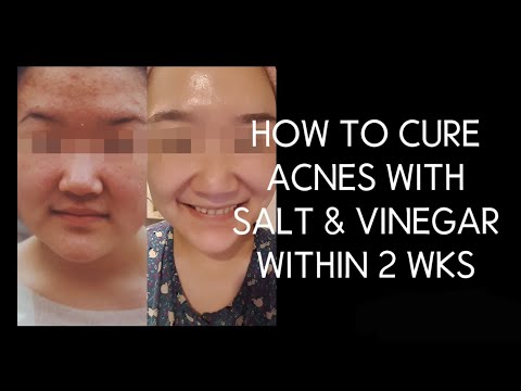 소금, 식초로 여드름 피부 탈출하기 How to cure acne with salt and vinegar