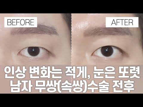 눈 성형 전후 | 남자 무쌍(속쌍)수술 전후