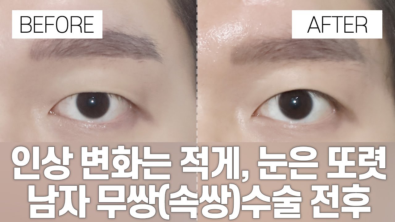 [Ганнам Соён гоо сайхны мэс заслын эмнэлэг] Нүдний гоо сайхны мэс заслын өмнө ба хойно | Эрэгтэй давхраагүй зовхи (далд давхраатай) мэс заслын өмнө ба хойно
