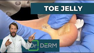 Toe Jelly Cyst | Dr. Derm