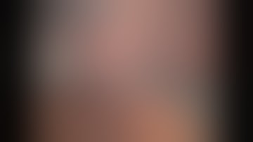 Robotic Cholecystectomy for Acute Calculous Cholecystitis on Da Vinci Xi using ICG & FireFly Mode