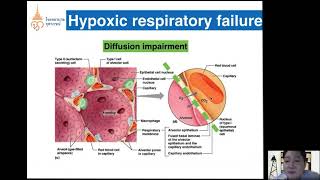 Respiratory Failure & Management โดยนายแพทย์ชนทัต ไตรทอง