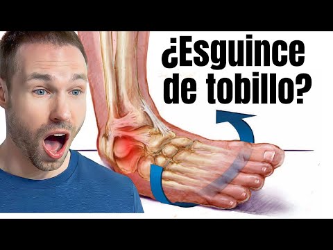 La verdad sobre los esguinces de tobillo: ¡Lo que los médicos no te dicen!