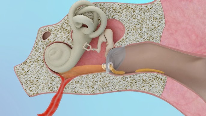 Stapedotomy Animation to Treat Otosclerosis (Curable Type of