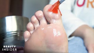 Chemical Foot Peel Removes Crusty Dead Skin and Callus Buildup