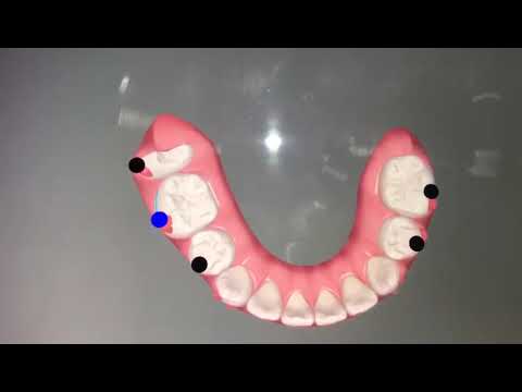 Maloclusión dental