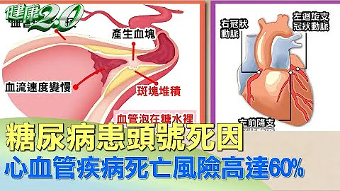 糖尿病患頭號死因 心血管疾病死亡風險高達60%  健康2.0 - 天天要聞