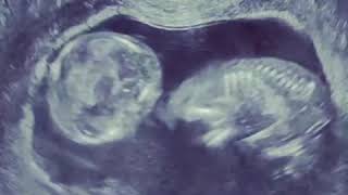 Ecografia Semana 13