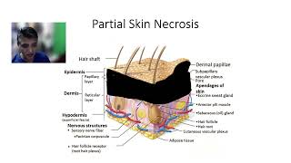 Stage II pressure injury (ulcer) & necrotic tissue