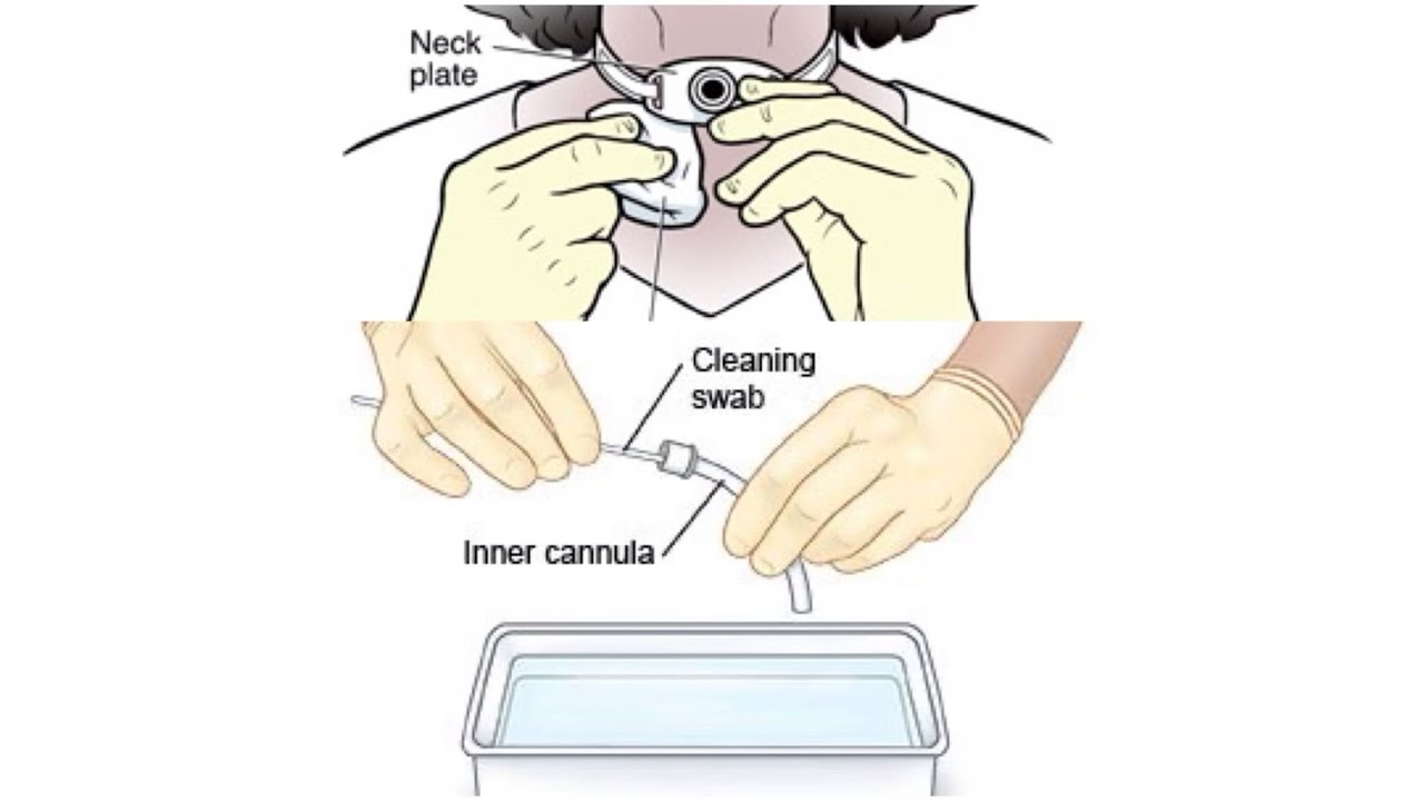 Tracheostomy Care by RT. Salma