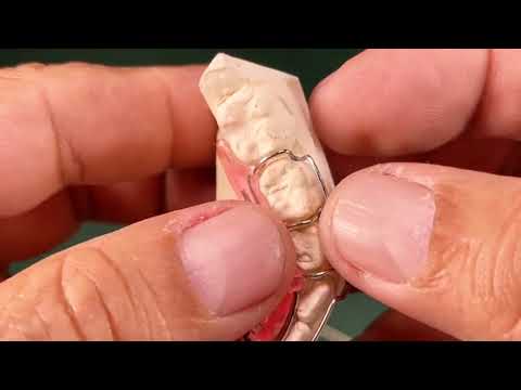 Adams Clasp: A determining factor in successful clinical outcomes with active plates.