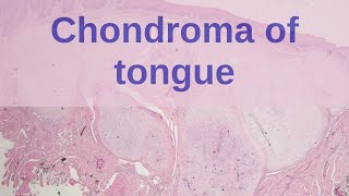 Soft Tissue Chondroma (STC) of the Tongue - Pathology mini tutorials screenshot 2