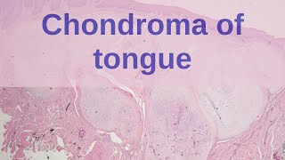 Soft Tissue Chondroma (STC) of the Tongue - Pathology mini tutorials screenshot 5