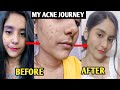 My Acne Journey Changes My Life 🧏 || How I Cleared my Skin in 3 Months 🪄