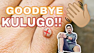 Paano Tanggalin Ang Kulugo? | Mura At Mabisang Paraan | BinoVlog Paano Tanggalin Ang Kulugo? | Mura At Mabisang Paraan | BinoVlog