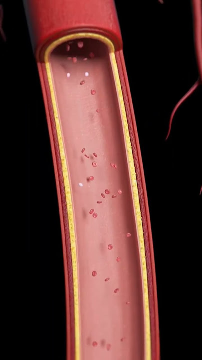 Download lagu 'Atherosclerosis explained in 30 seconds Watch learn, and stay heart-smart #admed #healthylifestyle