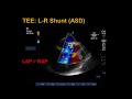 Transesophageal Echocardiography: Shunts and Bubble Study