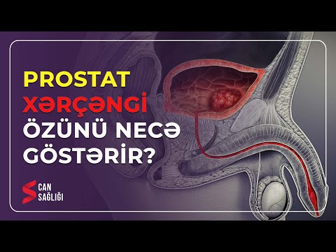 Kişilərdə prostat xərçəngi özünü necə göstəriri? (19.05.2023) - Medical Meida Live