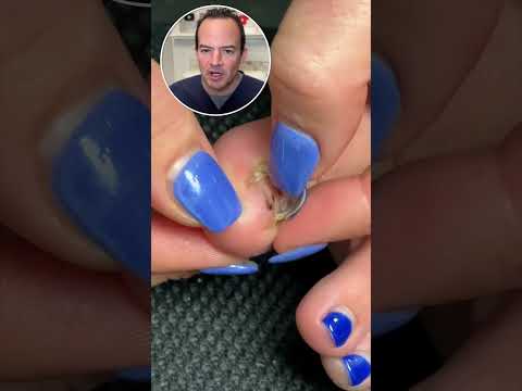 Video: Doare căderea unghiei de la picioare?