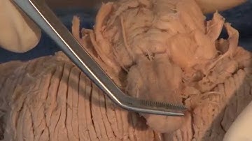 Cranial Nerves: Neuroanatomy Video Lab - Brain Dissections