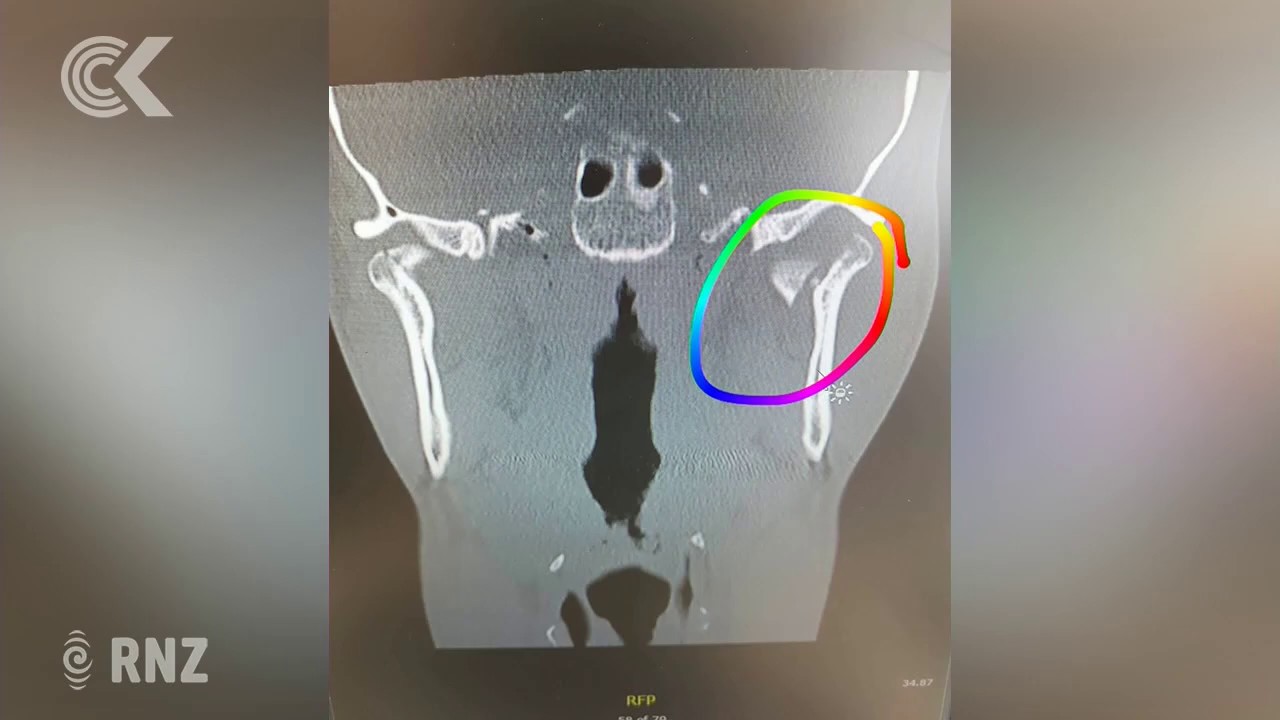 new zealand currency Injured Lime riders lament company’s slow response