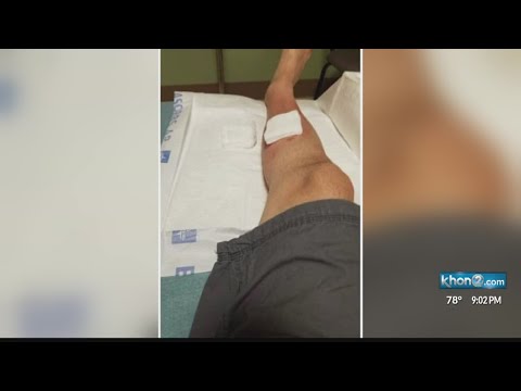 Spider bite lands Kapolei man in hospital