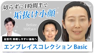 フェイスタイト・アキュタイト｜切らずに小顔リフトアップなら加藤