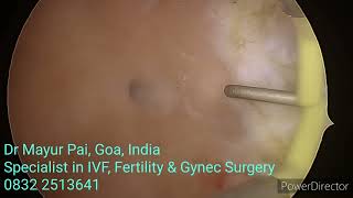 Uterine septum removal with bipolar resectoscope for Fertility enhancement
