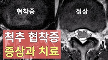 척추 협착증 증상,치료,디스크와의 차이점 #4