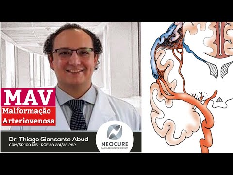 Vídeo: Malformação Arteriovenosa - Sintomas, Tratamento, Formas, Etapas, Diagnóstico